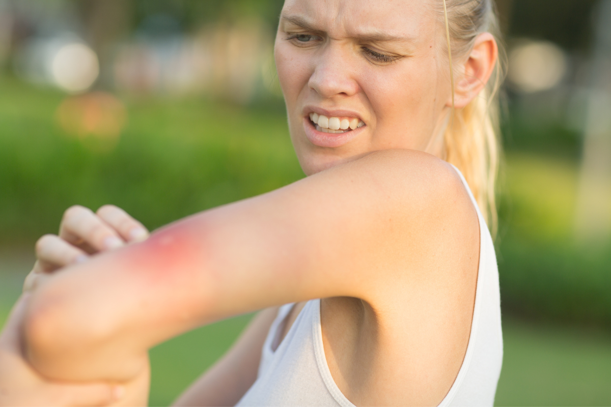 vrouw met insectenbeet